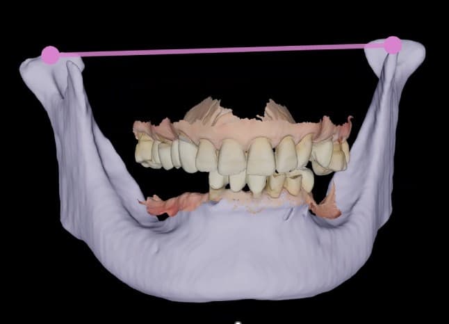 하악 3D 모델에 정렬한 구강스캔 데이터에서 앞니부 상·하악 치아의 위치를 확인하는 화면